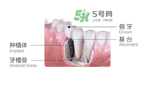 種植牙費(fèi)用多少錢(qián)？國(guó)產(chǎn)種植牙價(jià)格