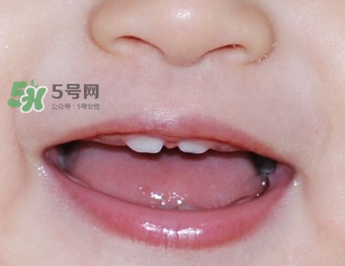 牙齒縫隙大怎么辦？牙縫大帶牙套有用嗎