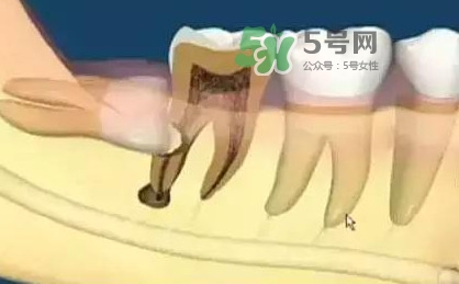 智齒是每個(gè)人都會長嗎？拔智齒能瘦臉嗎？
