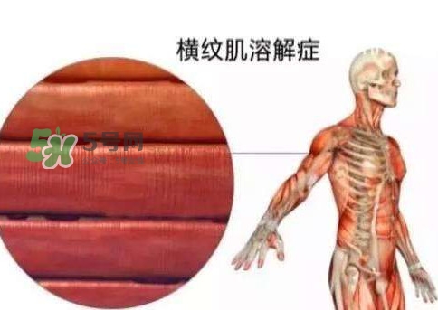 橫紋肌溶解癥會死亡嗎？橫紋肌溶解癥能活多久