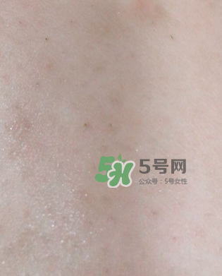 Dermatix舒痕疤痕膏有效嗎？Dermatix舒痕疤痕膏怎么用？