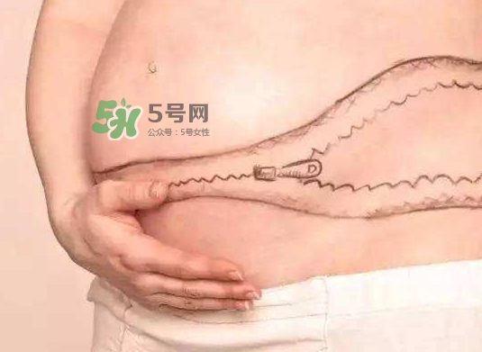 剖腹產(chǎn)疤痕怎么去除？剖腹產(chǎn)疤痕能去掉嗎？