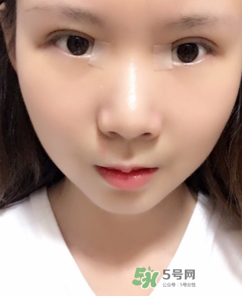 美皮護(hù)去疤效果怎么樣？美皮護(hù)有用嗎？