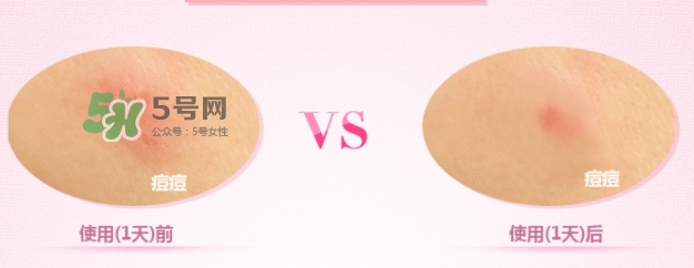 3m痘痘貼怎么用？3m痘痘貼貼多久？