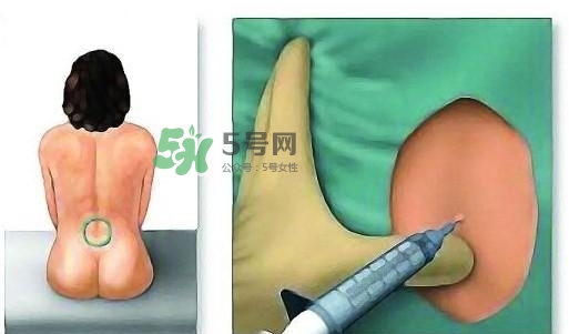 無痛分娩為什么不提倡？無痛分娩有后遺癥嗎？