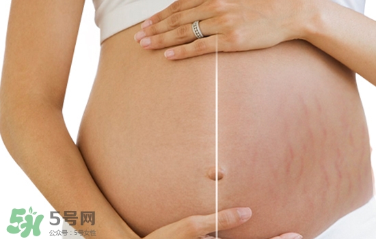 妊娠紋在左邊生男或女？怎么從妊娠紋看男女？