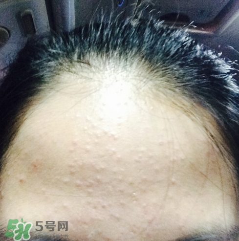 長痘長閉口怎么辦？長痘長閉口是什么原因？