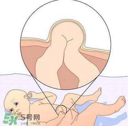 臍疝是什么？臍疝對(duì)寶寶有什么影響？
