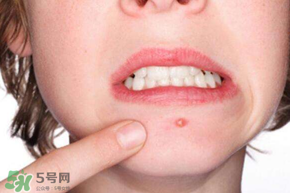 暗瘡可以擠壓?jiǎn)幔坑托院腕a臟肌膚會(huì)容易有暗瘡嗎？