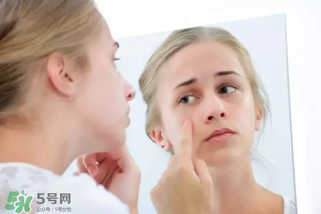 暗瘡可以擠壓?jiǎn)?？油性和骯臟肌膚會(huì)容易有暗瘡嗎？