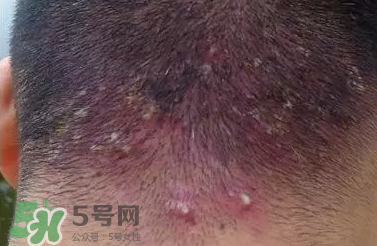 痤瘡和毛囊炎一樣嗎？痤瘡與毛囊炎區(qū)別