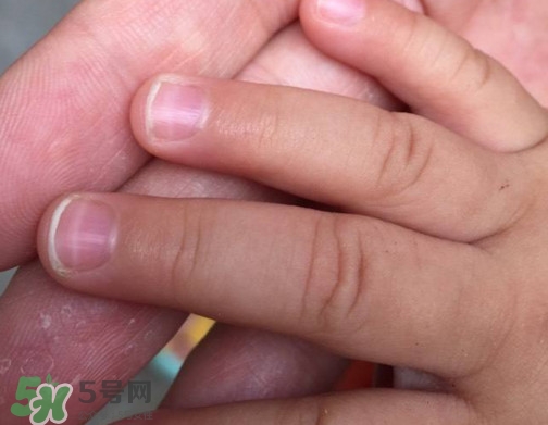 寶寶手指甲有白痕怎么回事？幼兒手指甲發(fā)白是缺鈣嗎