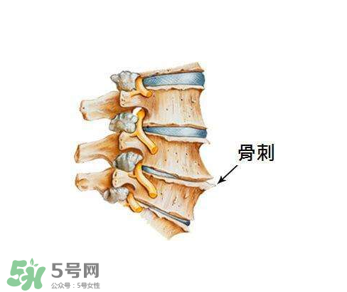 骨刺是怎么形成的？骨刺怎么治療？