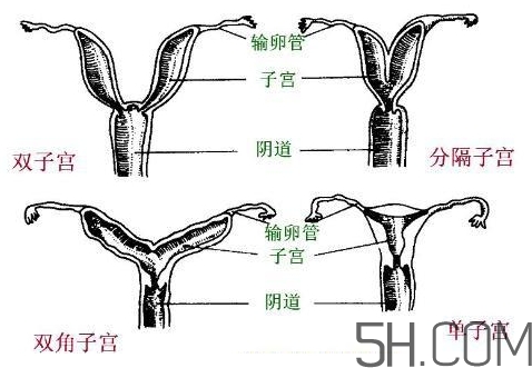 子宮畸形有哪些？子宮畸形有什么影響？