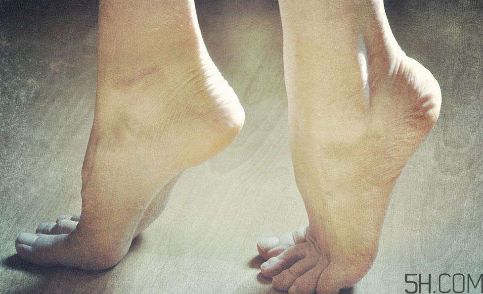 腳氣是什么原因引起的？腳氣是濕氣重引起的嗎?