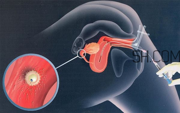人工授精取卵子怎么?。咳斯な诰腥嗽鯓尤【?？