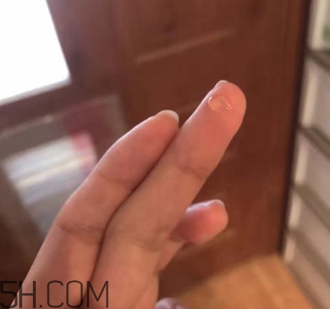 倍舒痕可以去痘印嗎？倍舒痕能涂在痘痘上嗎？