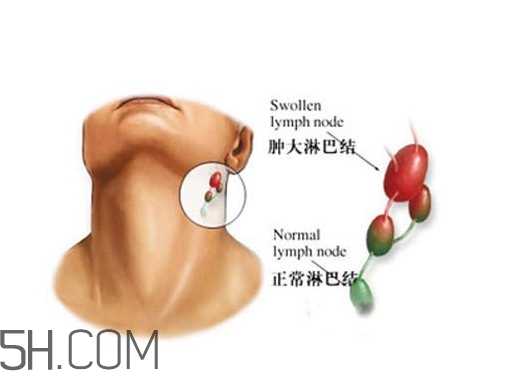 淋巴癌能活多久？淋巴癌癥狀有哪些