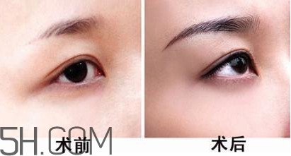 切眉手術(shù)后老得快嗎？切眉能保持多久？