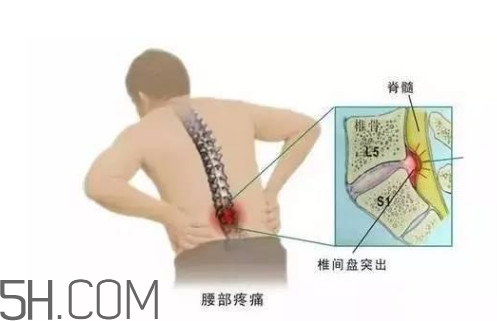 腰間盤(pán)突出是什么原因引起的？腰間盤(pán)突出是腎虛嗎