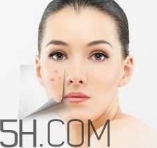 濕熱型痤瘡是什么？怎么調(diào)理濕熱型痤瘡？