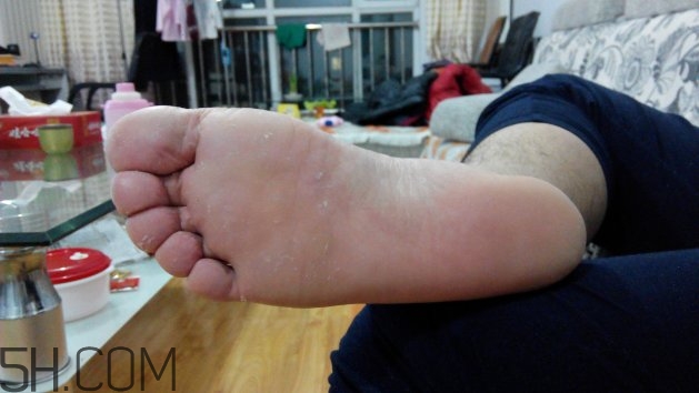 腳氣可以用酒精消毒嗎？腳氣可以用碘伏消毒嗎？