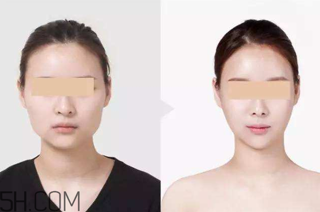 打瘦臉針可以抽煙嗎？打瘦臉針會(huì)反彈嗎？