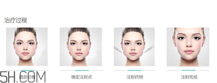 打瘦臉針可以抽煙嗎？打瘦臉針會(huì)反彈嗎？