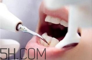 洗牙對(duì)牙齒好嗎？洗牙的6大誤區(qū)