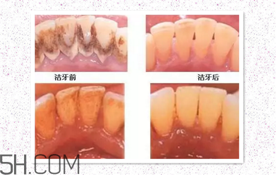 超聲波洗牙可以美白牙齒嗎？超聲波洗牙多少錢一次？