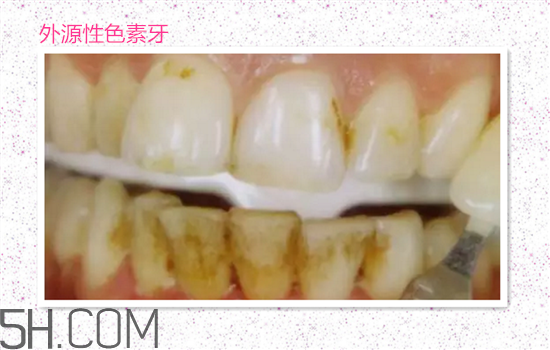 超聲波洗牙可以美白牙齒嗎？超聲波洗牙多少錢一次？