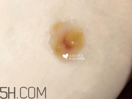 美寶濕潤燒傷膏怎么樣？美寶濕潤燒傷膏有用嗎？