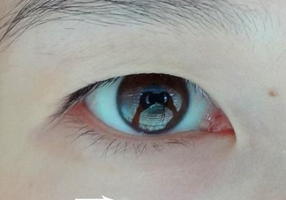 為什么會長脂肪粒？怎么消除眼睛上的脂肪粒？