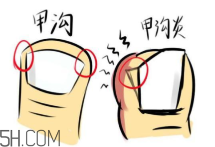 為什么容易得甲溝炎？怎么根治甲溝炎？