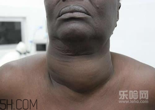 甲狀腺腫大和甲亢的區(qū)別有哪些？甲狀腺腫大適合吃什么食物？