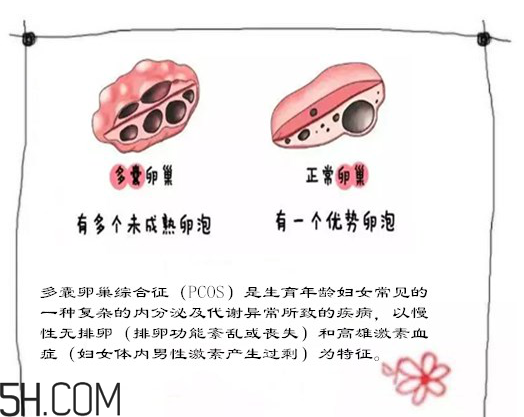 多囊卵巢生不了？多囊卵巢懷孕要看準(zhǔn)時(shí)間