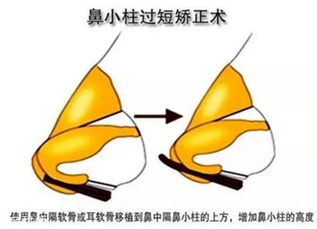 鼻小柱延長(zhǎng)用什么材料？?jī)?yōu)先選擇鼻中隔軟骨