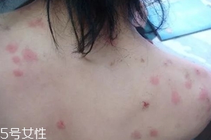 螨蟲(chóng)有哪些危害？嚴(yán)重時(shí)肌膚糜爛