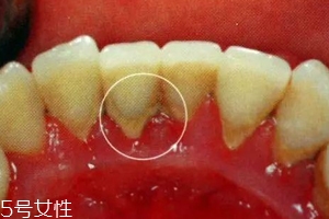牙結(jié)石能自動脫落嗎？除了洗牙別無他法
