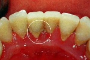 牙結(jié)石能自動(dòng)脫落嗎？除了洗牙別無(wú)他法