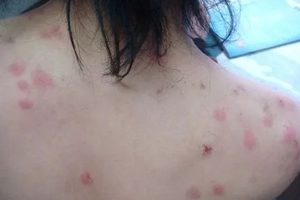 螨蟲有哪些危害？嚴(yán)重時肌膚糜爛