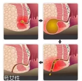 肛瘺非手術(shù)治療才可以嗎？手術(shù)是治療的關(guān)鍵途徑