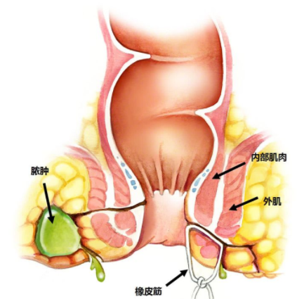 肛瘺非手術(shù)治療才可以嗎？手術(shù)是治療的關(guān)鍵途徑