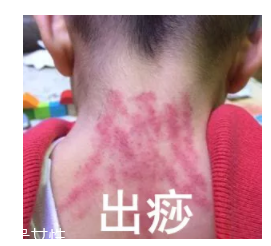 吮痧有什么療效？最溫柔的治病方法