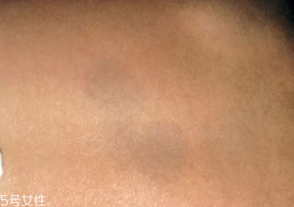 痣什么情況下會轉變?yōu)榱觯奎c痣不可取