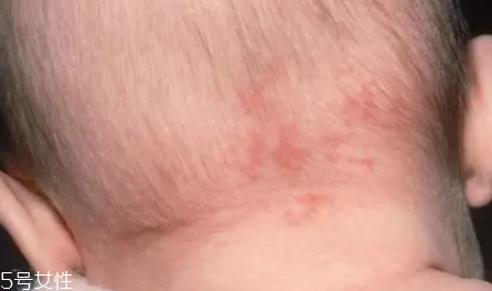 痣什么情況下會轉變?yōu)榱?？點痣不可取