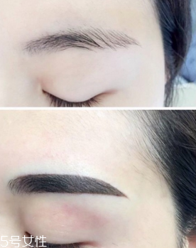 激光洗眉恢復期有疤痕怎么辦？激光洗眉毛之后正確護理方法
