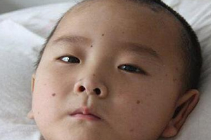 痣什么情況下會(huì)轉(zhuǎn)變?yōu)榱?？點(diǎn)痣不可取