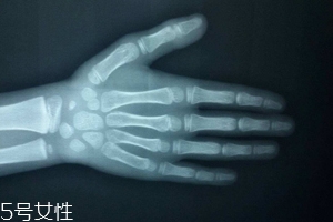 哪些人需要測骨齡？長太快警惕骨齡提前