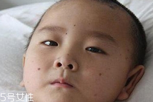 痣什么情況下會轉變?yōu)榱?？點痣不可取